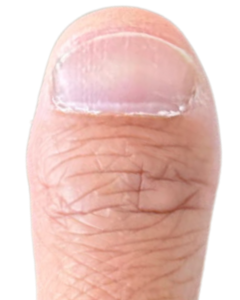 Pat’s Thumb